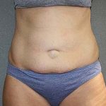 Tummy Tuck Before & After Patient #7243