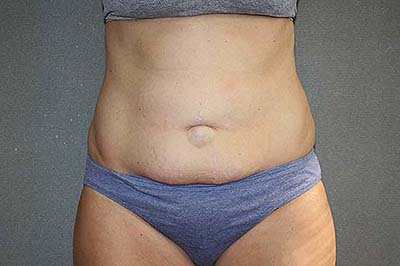 Tummy Tuck Before & After Patient #7243