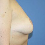 Breast Reduction Before & After Patient #7300