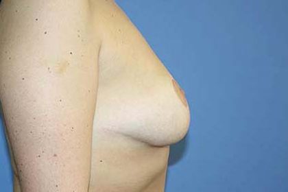 Breast Reduction Before & After Patient #7300