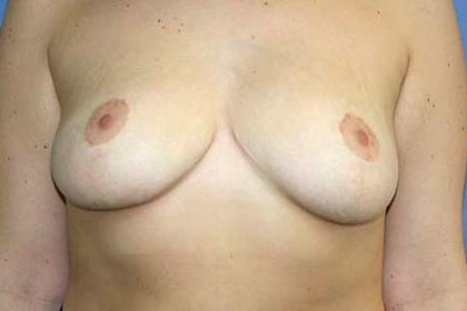 Breast Reduction Before & After Patient #7300