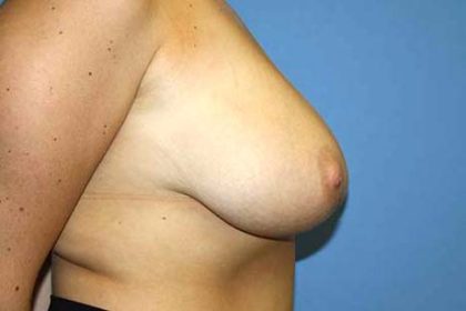 Breast Reduction Before & After Patient #7300