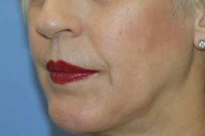 Chin Augmentation Before & After Patient #7302