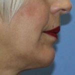 Chin Augmentation Before & After Patient #7302