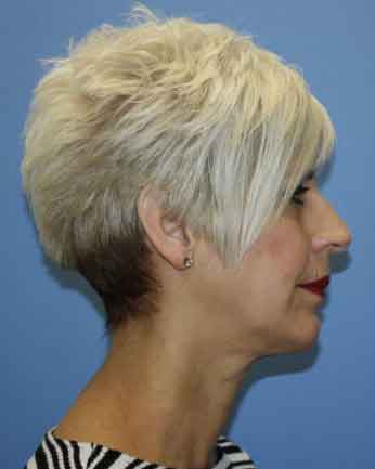 Chin Augmentation Before & After Patient #7341