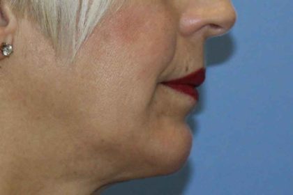 Chin Augmentation Before & After Patient #7302