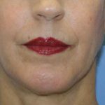 Chin Augmentation Before & After Patient #7302