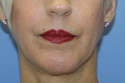 Chin Augmentation Before & After Patient #7302