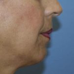 Chin Augmentation Before & After Patient #7302