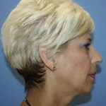 Chin Augmentation Before & After Patient #7341