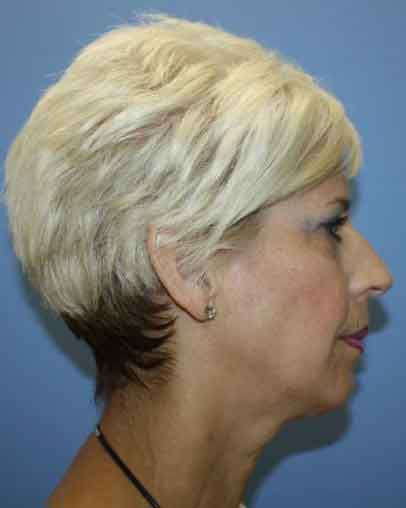 Chin Augmentation Before & After Patient #7341