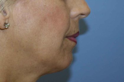 Chin Augmentation Before & After Patient #7302