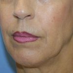 Chin Augmentation Before & After Patient #7302