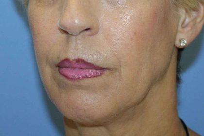 Chin Augmentation Before & After Patient #7302