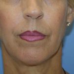 Chin Augmentation Before & After Patient #7302