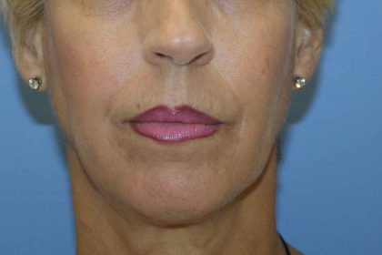 Chin Augmentation Before & After Patient #7302