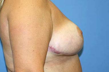 Breast Reduction Before & After Patient #7299