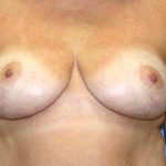 Breast Reduction Before & After Patient #7299