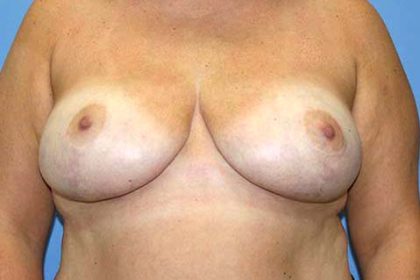 Breast Reduction Before & After Patient #7299