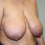 Breast Reduction Before & After Patient #7299