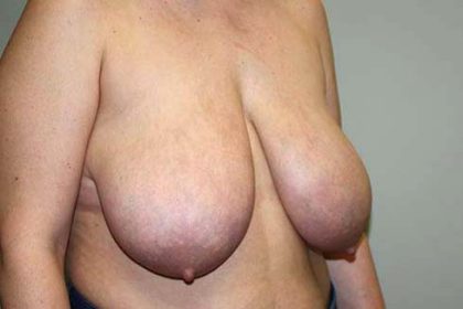 Breast Reduction Before & After Patient #7299