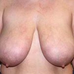 Breast Reduction Before & After Patient #7299