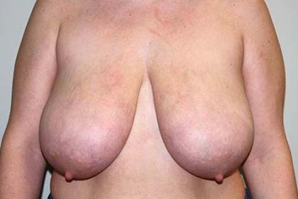 Breast Reduction Before & After Patient #7299