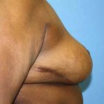 Breast Reduction Before & After Patient #5739