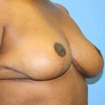 Breast Reduction Before & After Patient #5739