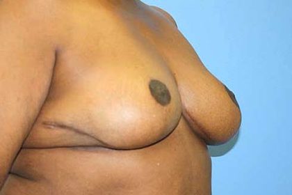 Breast Reduction Before & After Patient #5739