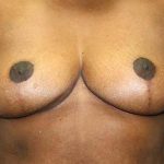 Breast Reduction Before & After Patient #5739