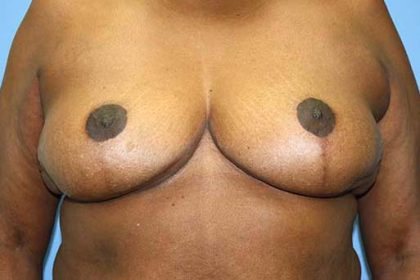 Breast Reduction Before & After Patient #5739