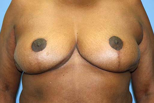 Breast Reduction Before & After Patient #5739