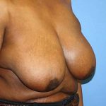 Breast Reduction Before & After Patient #5739