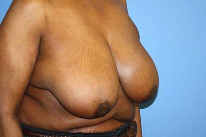 Breast Reduction Before & After Patient #5739