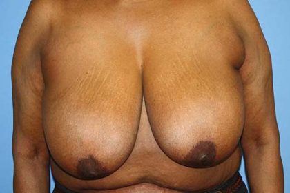 Breast Reduction Before & After Patient #5739