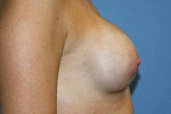 Breast Augmentation Before & After Patient #5740