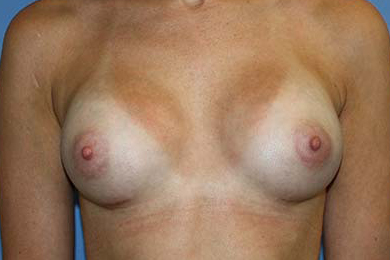 Breast Augmentation Before & After Patient #5740