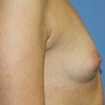 Breast Augmentation Before & After Patient #5740