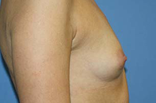 Breast Augmentation Before & After Patient #5740