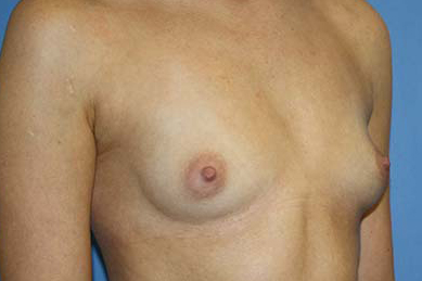 Breast Augmentation Before & After Patient #5740