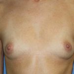 Breast Augmentation Before & After Patient #5740