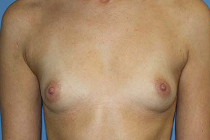 Breast Augmentation Before & After Patient #5740