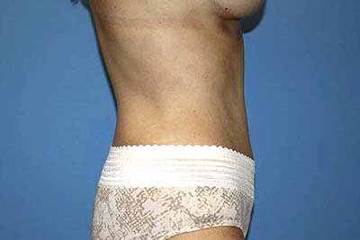 Tummy Tuck Before & After Patient #6940