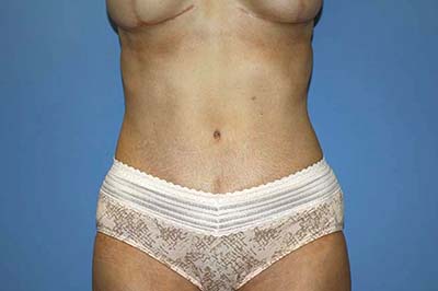 Tummy Tuck Before & After Patient #6940