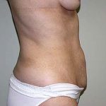 Tummy Tuck Before & After Patient #6940