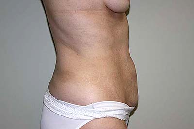 Tummy Tuck Before & After Patient #6940