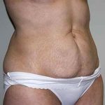 Tummy Tuck Before & After Patient #6940
