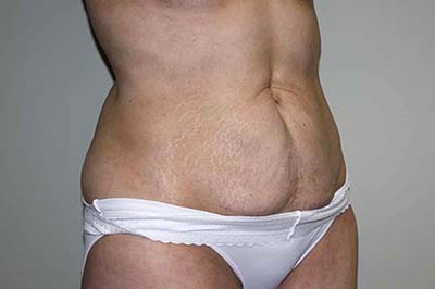 Tummy Tuck Before & After Patient #6940