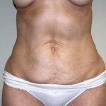 Tummy Tuck Before & After Patient #6940